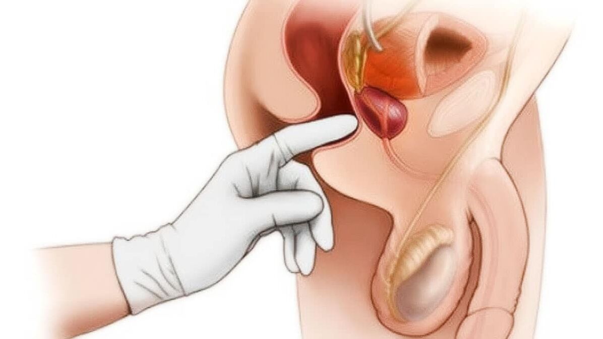diagnóstico de prostatitis y su tratamiento con el dispositivo