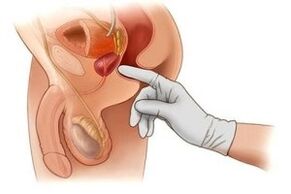 diagnóstico rectal de prostatitis