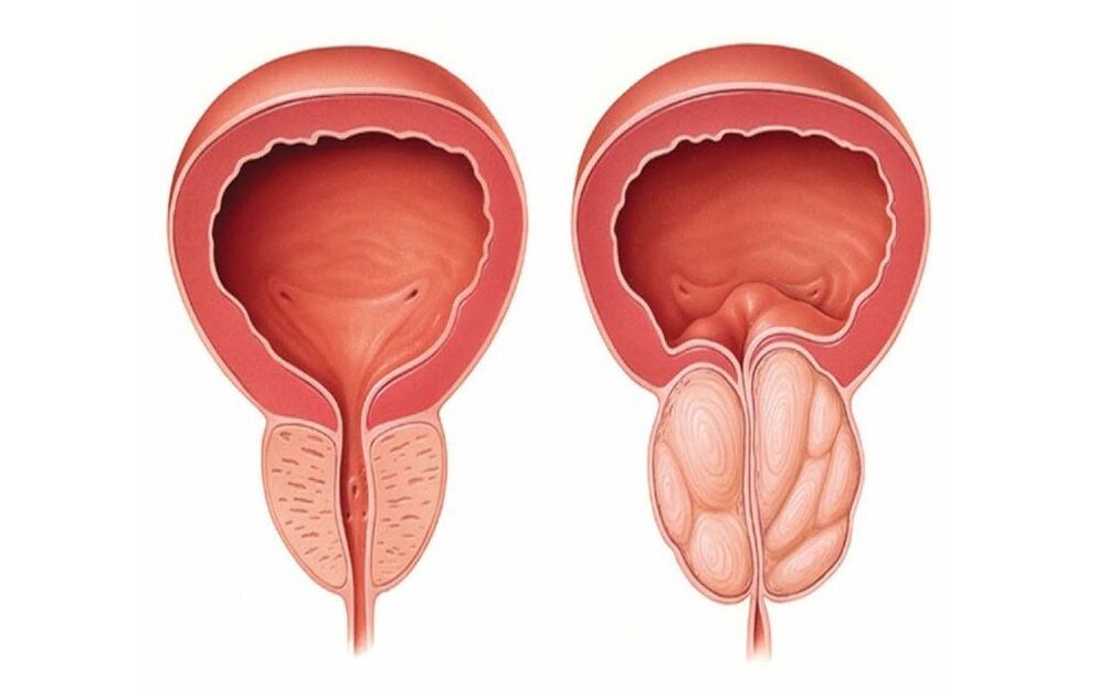 próstata normal e inflamada