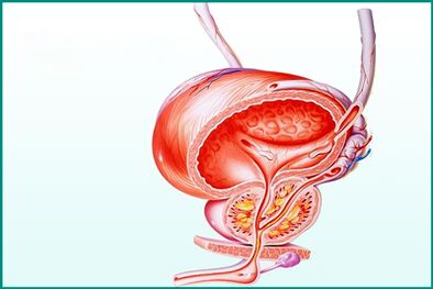 La inflamación de la próstata en la prostatitis aguda es una limitación para el sexo