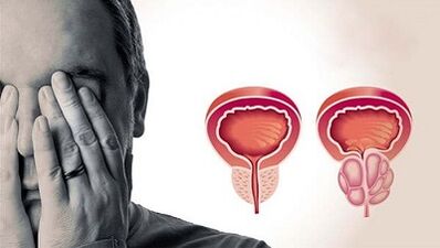 Las razones para el desarrollo de la prostatitis en los hombres