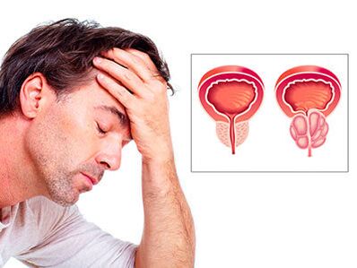 Los síntomas de la prostatitis preocupan al hombre.