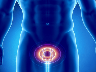 Prostatitis inflamación de la glándula prostática en un hombre.
