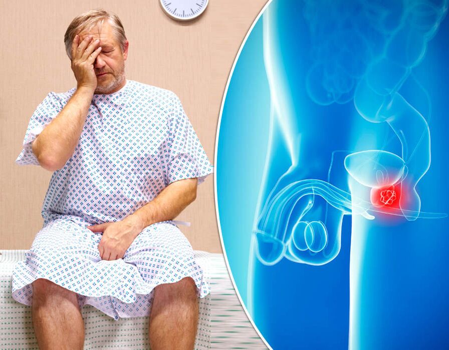 Un hombre con prostatitis está siendo diagnosticado con una enfermedad. 